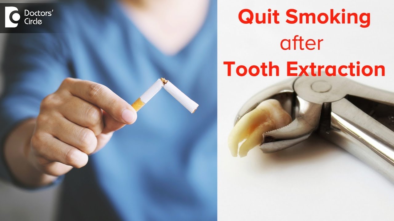 Do I need to quit smoking after tooth extraction? | Prevent Dry Socket - Dr. Rizwana Tarannum