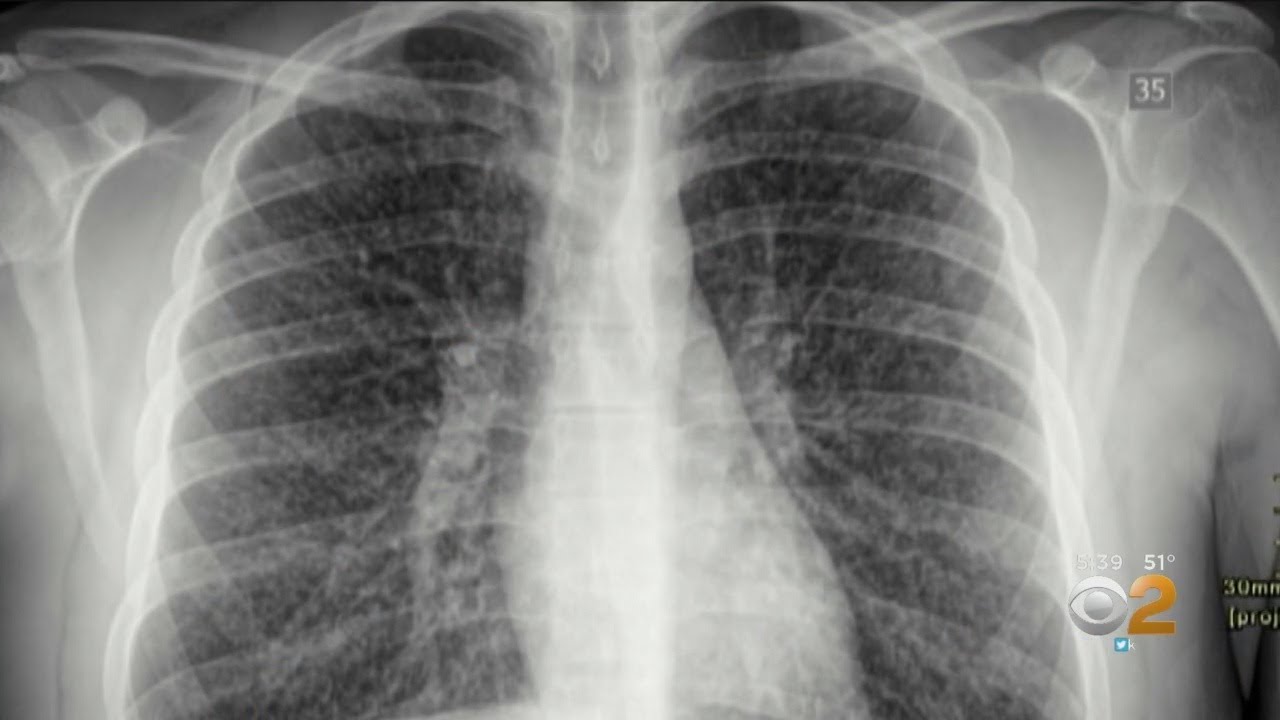 Lekarze twierdzą, że wapowanie może powodować „Popcorn Lung”